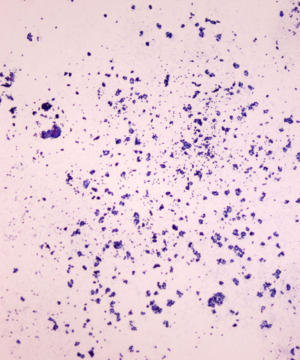 04 : Thyroid Follicular Neoplasm
