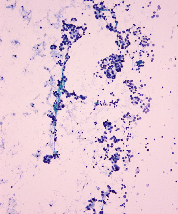 05 : Thyroid Follicular Neoplasm