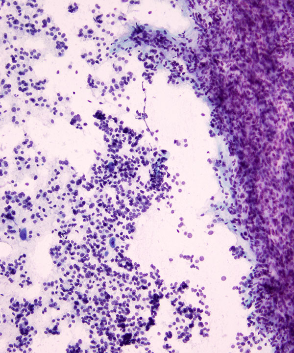 06 : Thyroid Follicular Neoplasm