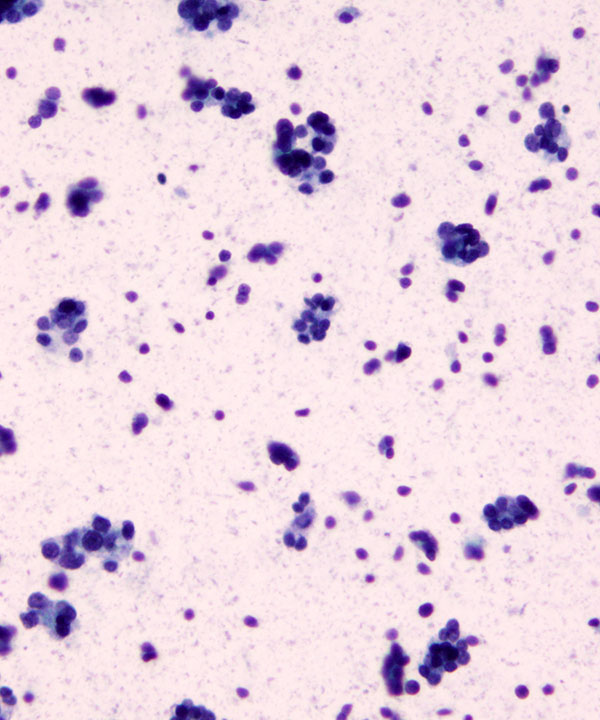 07 : Thyroid Follicular Neoplasm