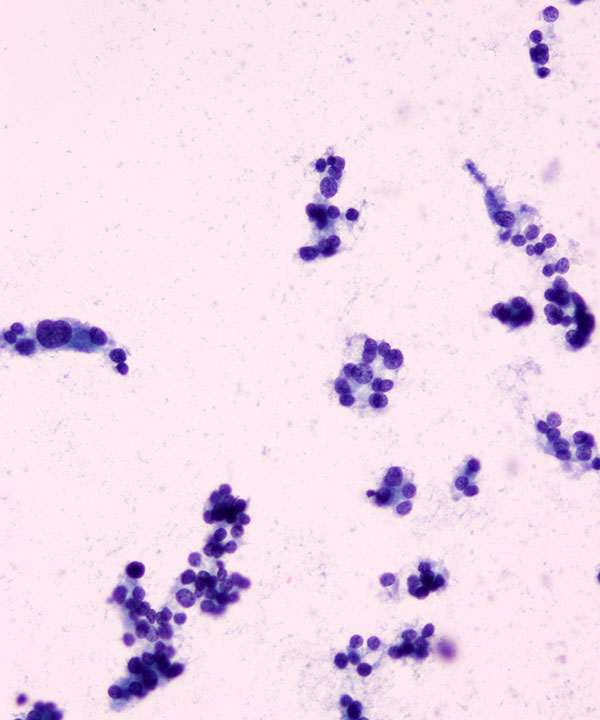 image showing 'Follicular Neoplasm'