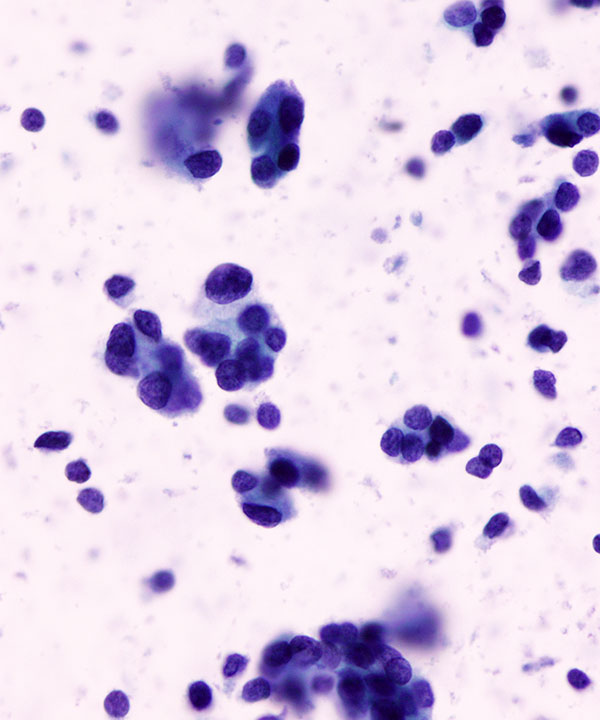10 : Thyroid Follicular Neoplasm