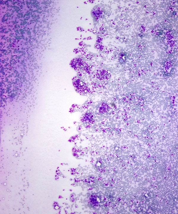 image showing 'Hürthle Cell Neoplasm'