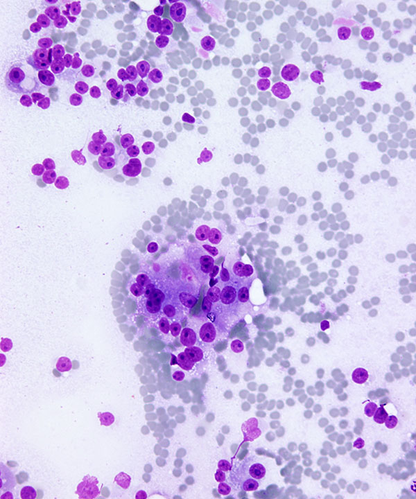 2 : Thyroid Hürthle Cell Neoplasm