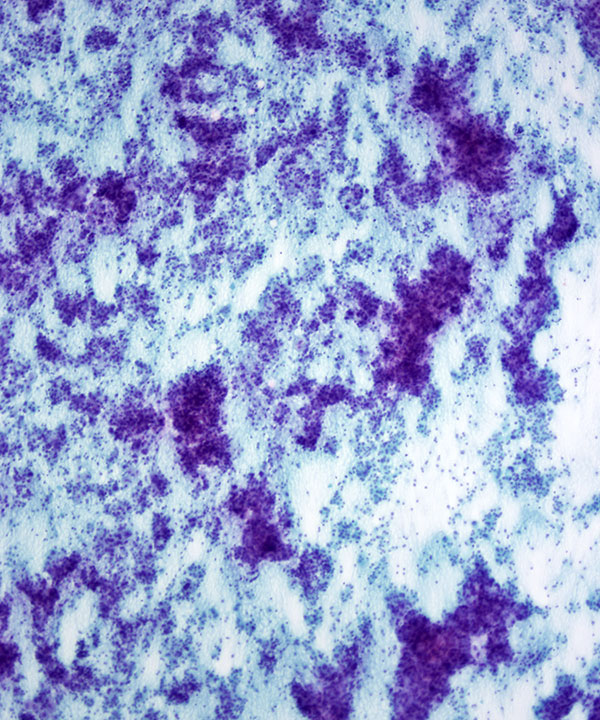 3 : Thyroid Hürthle Cell Neoplasm