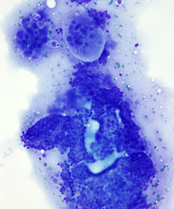 07 : ThyroidPapillaryCarcinoma