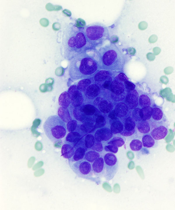 04 : ThyroidPapillaryCarcinoma