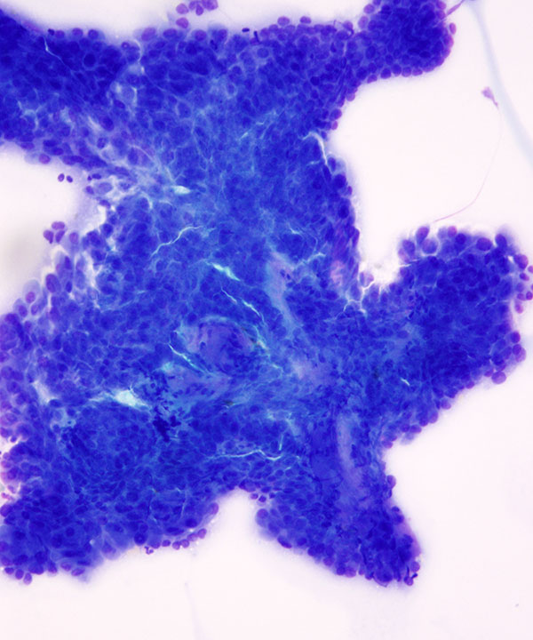 02 : ThyroidPapillaryCarcinoma