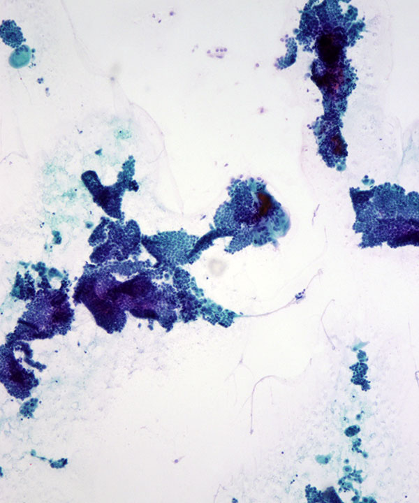 03 : ThyroidPapillaryCarcinoma