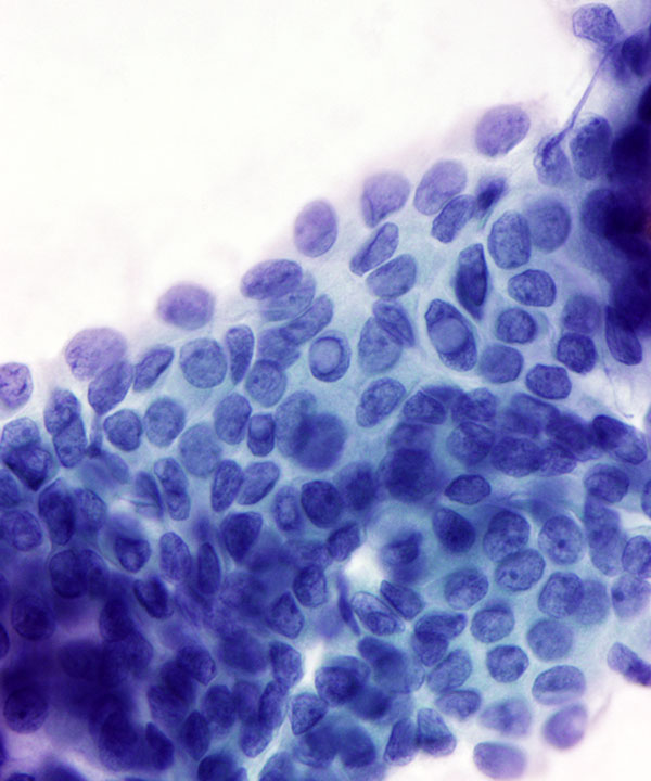 05 : ThyroidPapillaryCarcinoma