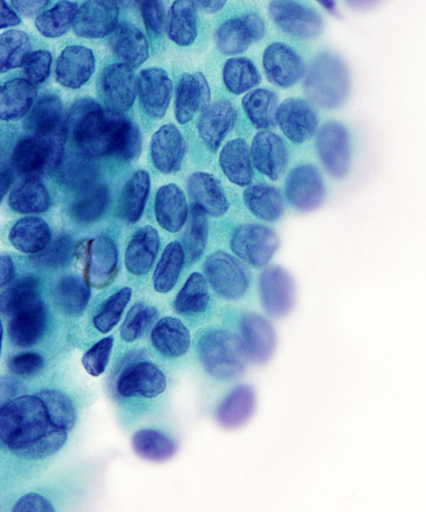06 : ThyroidPapillaryCarcinoma