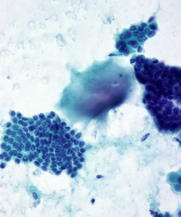 08 : ThyroidPapillaryCarcinoma