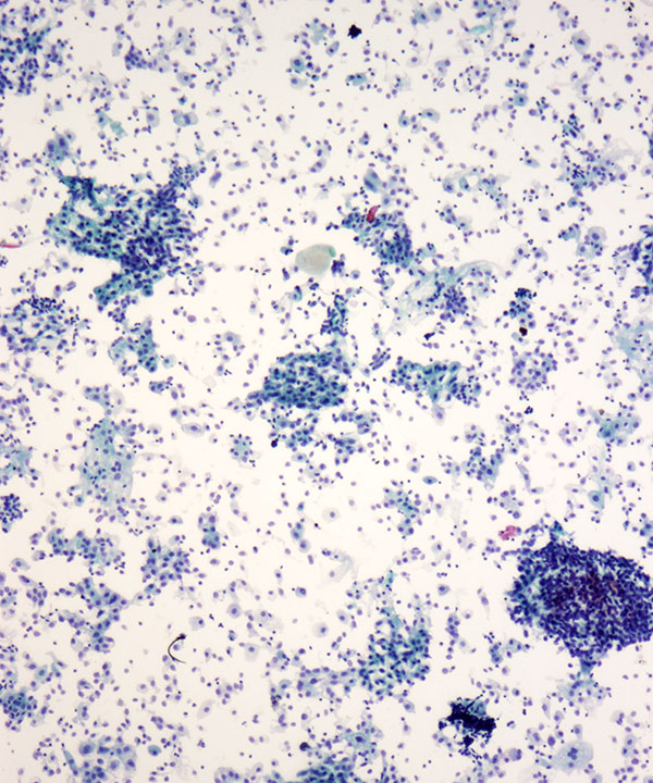 image showing 'Benign Renal Pelvic Washing'