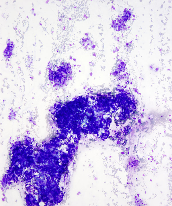 image showing 'Adenocarcinoma of Bladder'