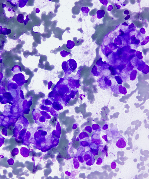 03 : Urine Bladder Adenocarcinoma