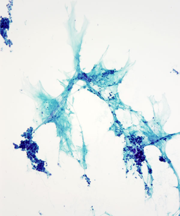 04 : Urine Bladder Adenocarcinoma