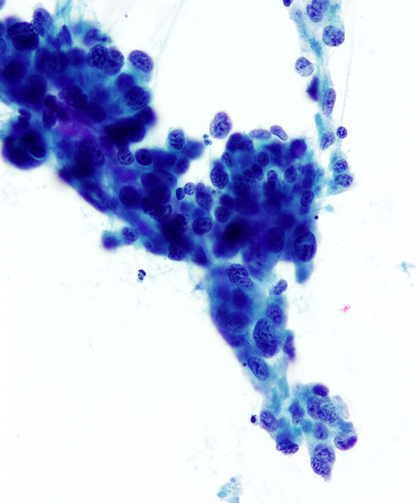 05 : Urine Bladder Adenocarcinoma