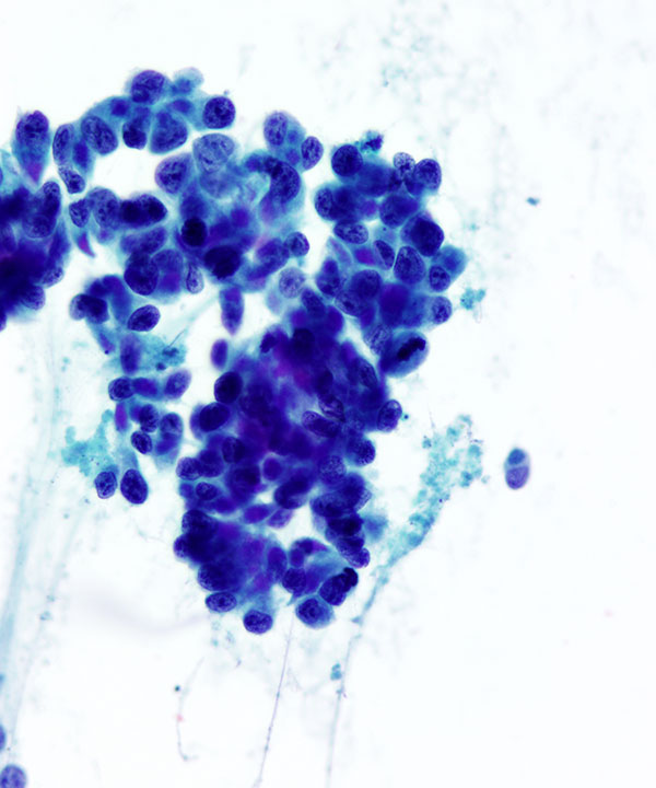 06 : Urine Bladder Adenocarcinoma