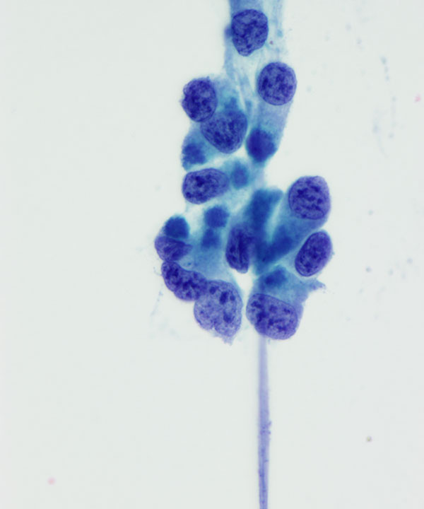 07 : Urine Bladder Adenocarcinoma