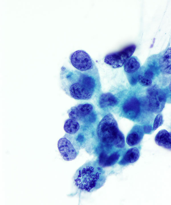 08 : Urine Bladder Adenocarcinoma