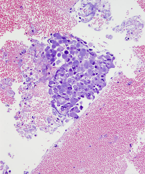 09 : Urine Bladder Adenocarcinoma