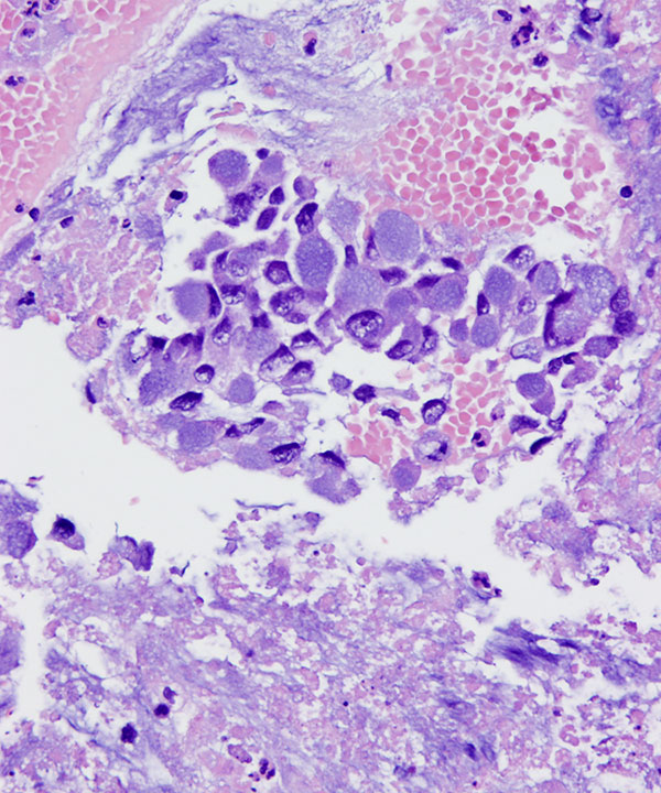 10 : Urine Bladder Adenocarcinoma