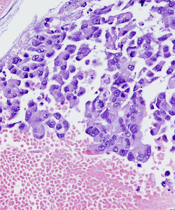 11 : Urine Bladder Adenocarcinoma