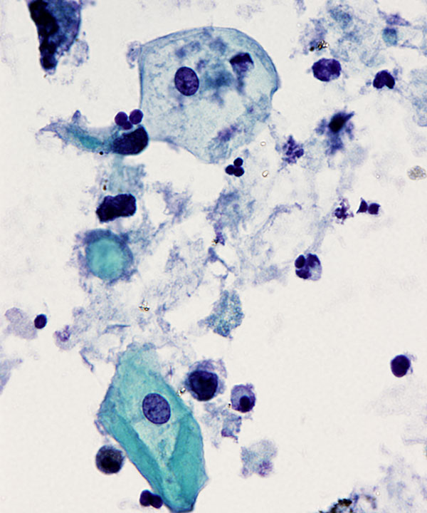 02 : Urine High Grade Urothelial Carcinoma