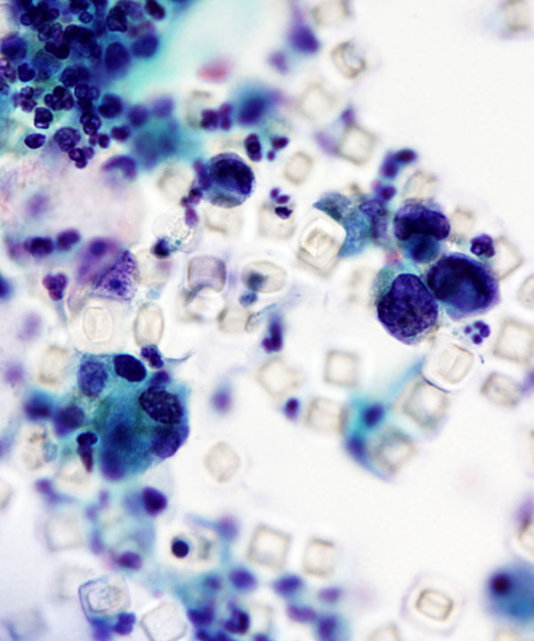 03 : Urine High Grade Urothelial Carcinoma