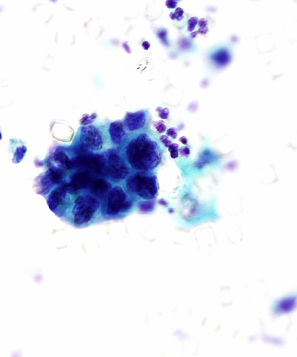 04 : Urine High Grade Urothelial Carcinoma