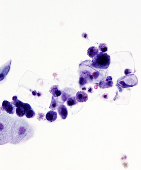 05 : Urine High Grade Urothelial Carcinoma