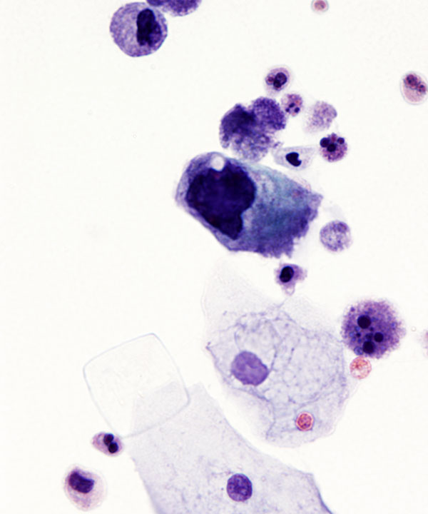 06 : Urine High Grade Urothelial Carcinoma