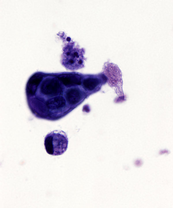08 : Urine High Grade Urothelial Carcinoma