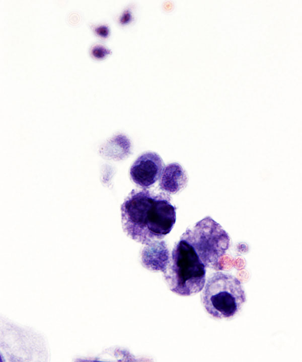09 : Urine High Grade Urothelial Carcinoma