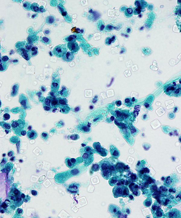 2 : Urine Ileal Conduit