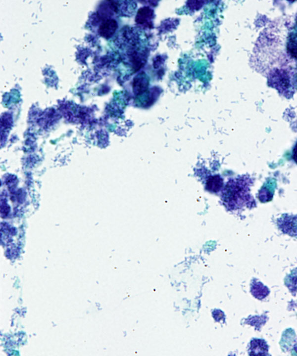3 : Urine Ileal Conduit