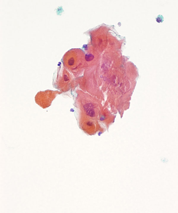 02 : Urine Keratinizing Squamous Cell Carcinoma