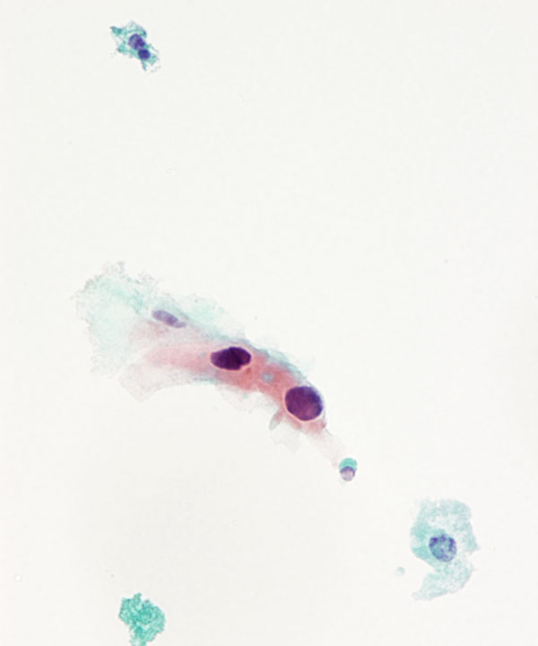 03 : Urine Keratinizing Squamous Cell Carcinoma