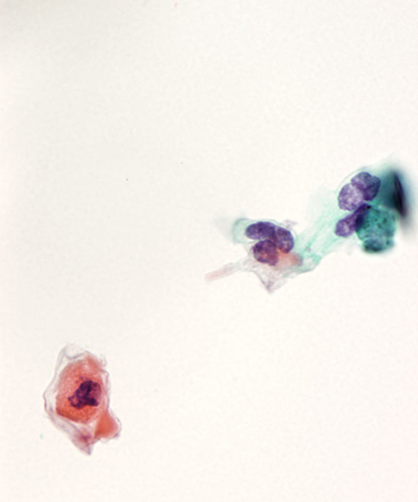 04 : Urine Keratinizing Squamous Cell Carcinoma