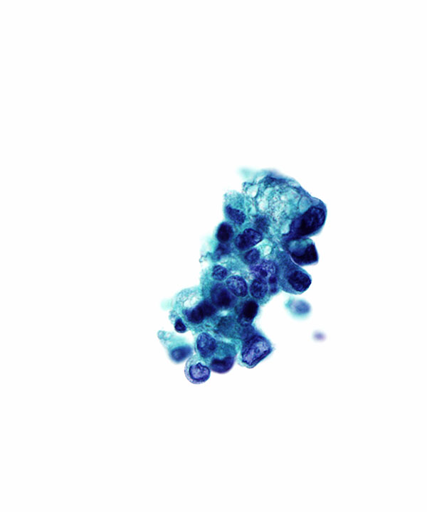 image showing 'Low Grade Urothelial Carcinoma'