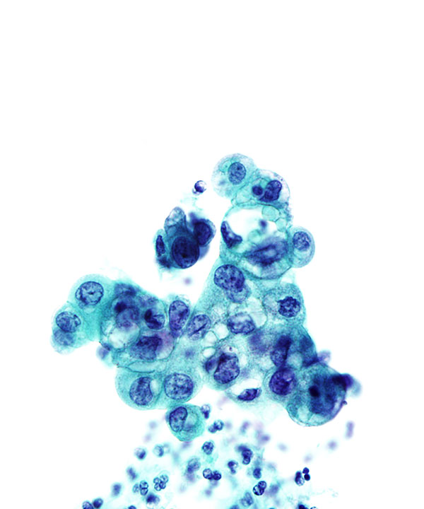 02 : Urine Low Grade Urothelial Carcinoma