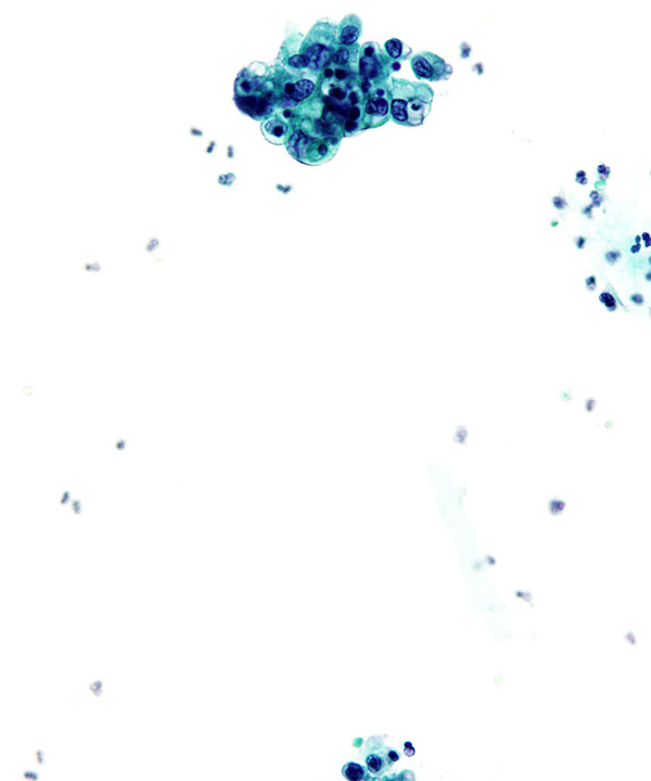03 : Urine Low Grade Urothelial Carcinoma
