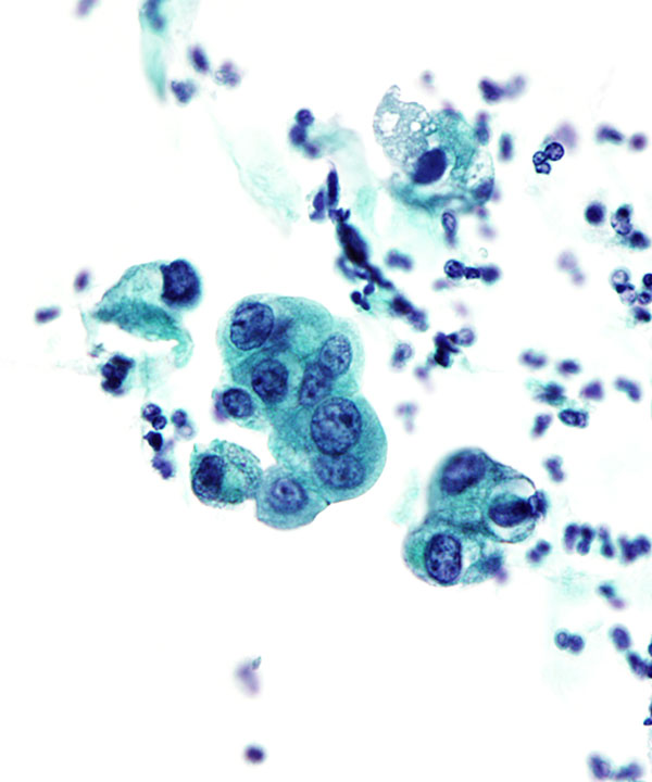 04 : Urine Low Grade Urothelial Carcinoma