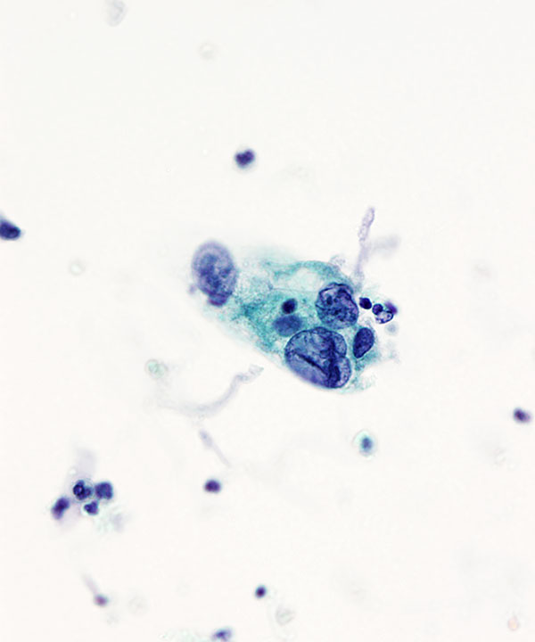 06 : Urine Low Grade Urothelial Carcinoma