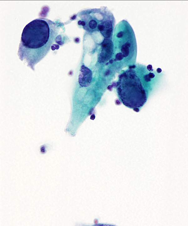 02 : Urine Polyoma Virus Infection