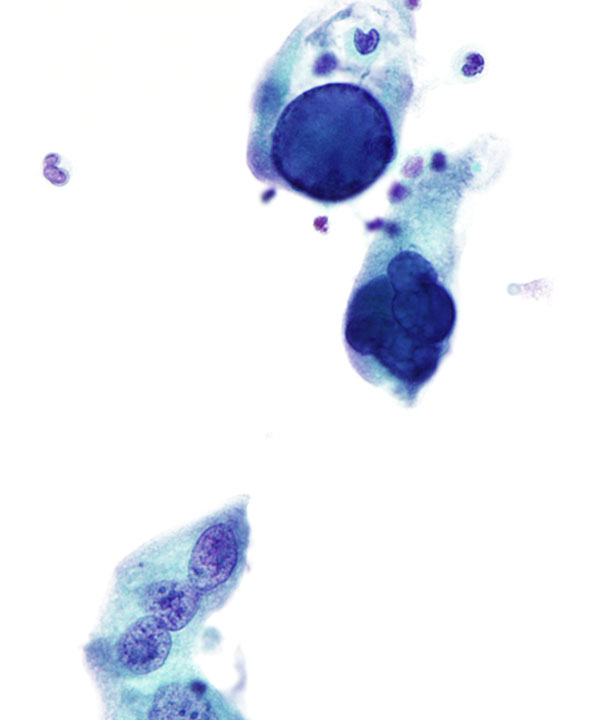 03 : Urine Polyoma Virus Infection