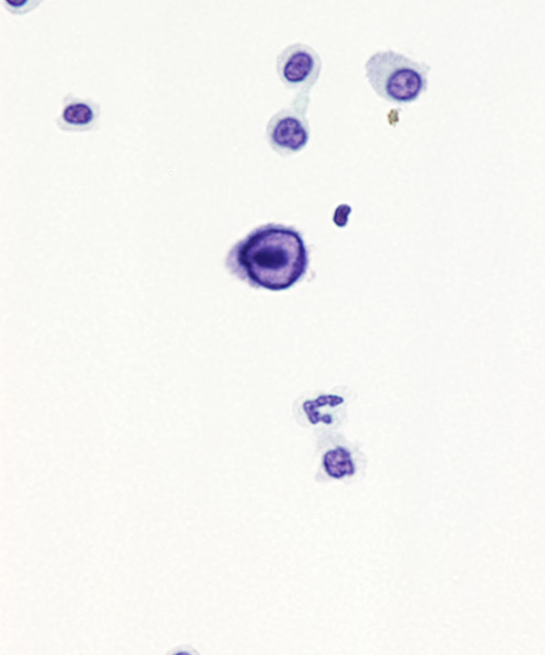 04 : Urine Polyoma Virus Infection