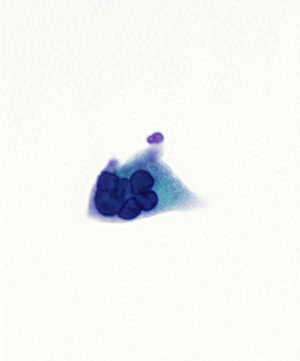 06 : Urine Polyoma Virus Infection