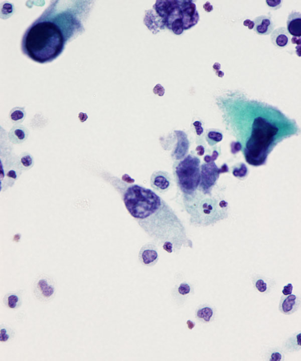 07 : Urine Polyoma Virus Infection