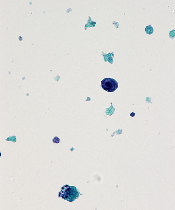 08 : Urine Polyoma Virus Infection